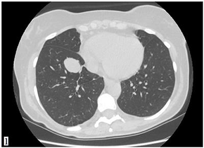 An Unusual Histology for a Lung Nodule: A Case Report of Primary Pulmonary Paraganglioma